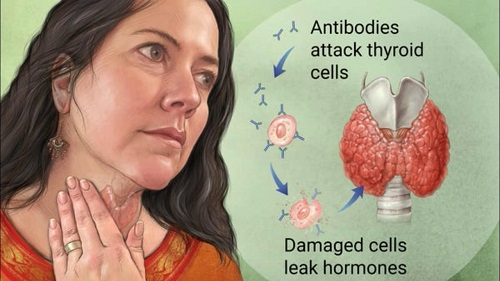 Viêm tuyến giáp Hashimoto - Hình ảnh minh họa